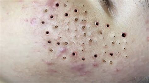 Pimple Popper's new Youtube video, she squeezes a ton of <b>steatocystomas</b> on a beloved patient. . Popping steatocystomas sac dep spa
